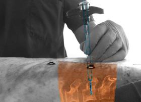 飞利浦推出用于微创手术的增强现实导航设备